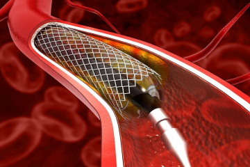 達成獨家協議！放療巨頭布局心血管領域